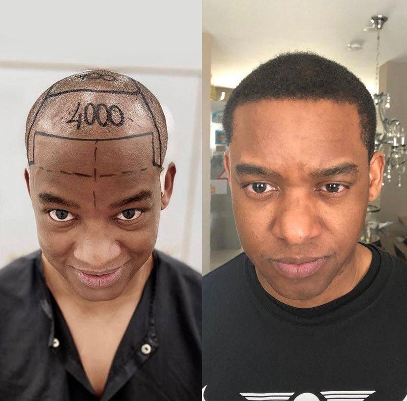 before-after-hair-transplant-turkey